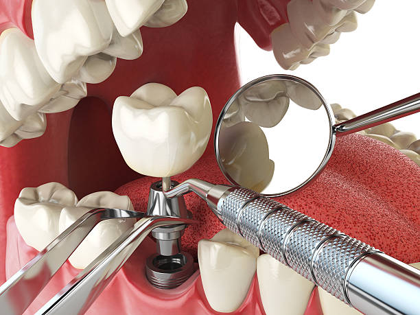 Best Urgent Care for Lost Fillings or Crowns in Pheasant Run, OH